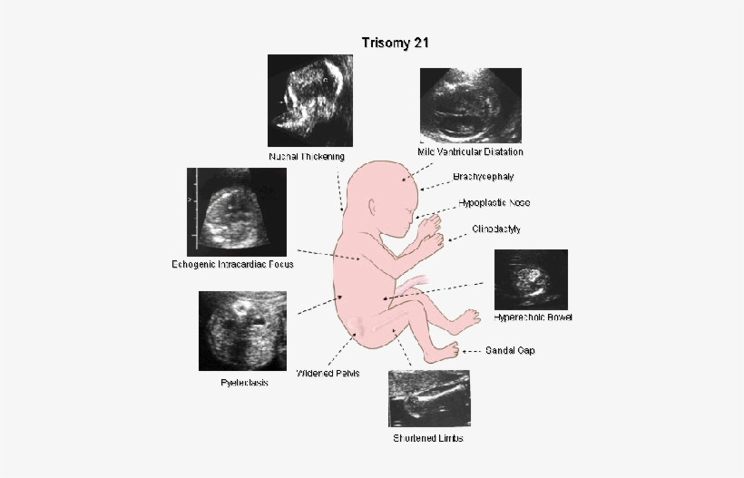 Soft Sign Down Syndrome, transparent png download