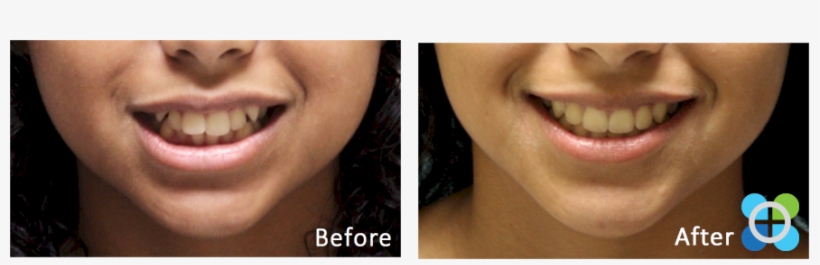 2 Orthodontique Before After Braces - Dental Braces, transparent png download