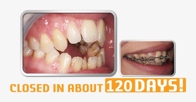 Prev - Fast Braces, transparent png download