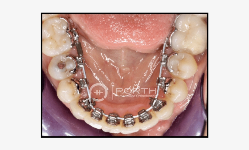Sammamish Lingual Braces - Lingual Braces, transparent png download