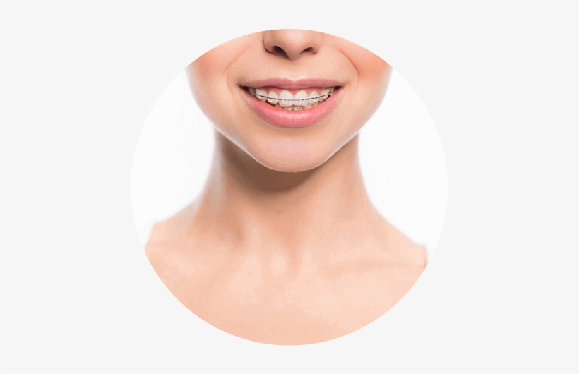 Clear Braces - Dental Braces, transparent png download