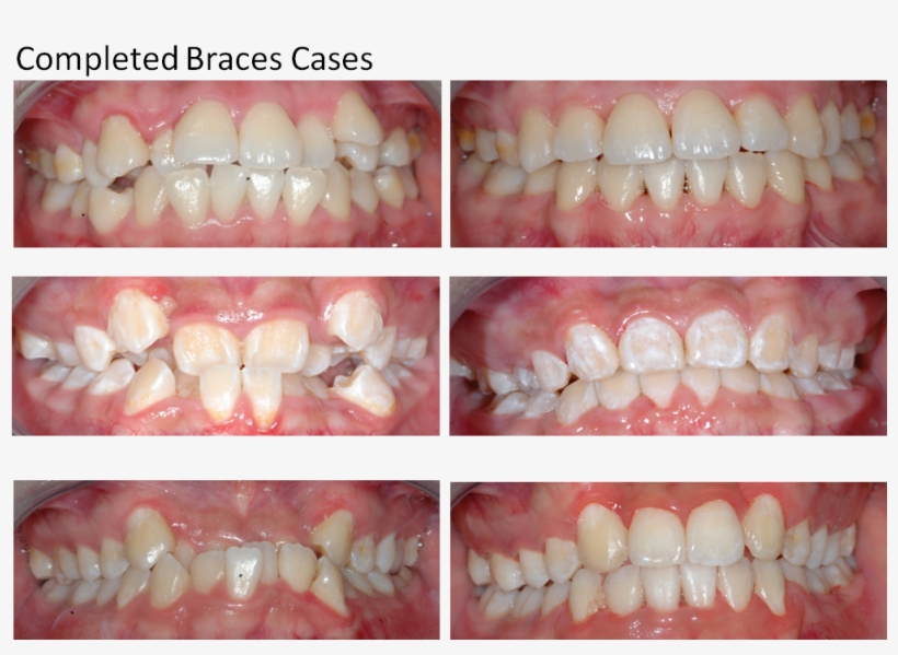 Dental Braces, transparent png download