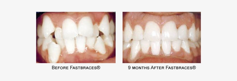 General Orthodontic Information - Fastbraces Nz, transparent png download