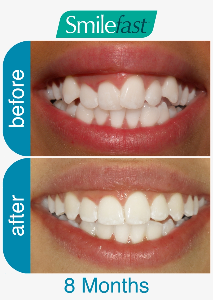 Aqd Smilefast After 7 Months2 Aqd Smilefast After 8 - Smilefast Before And After, transparent png download