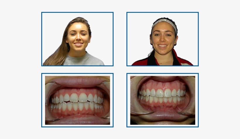 Before And After - Overjet, transparent png download