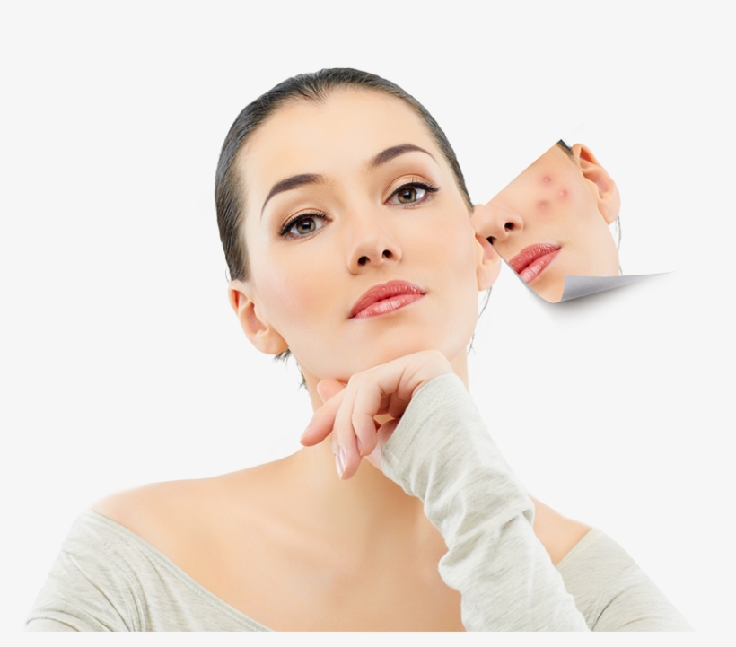 Anti-acne - Veluxio Naturals Best Blackhead Remover And Comedone, transparent png download