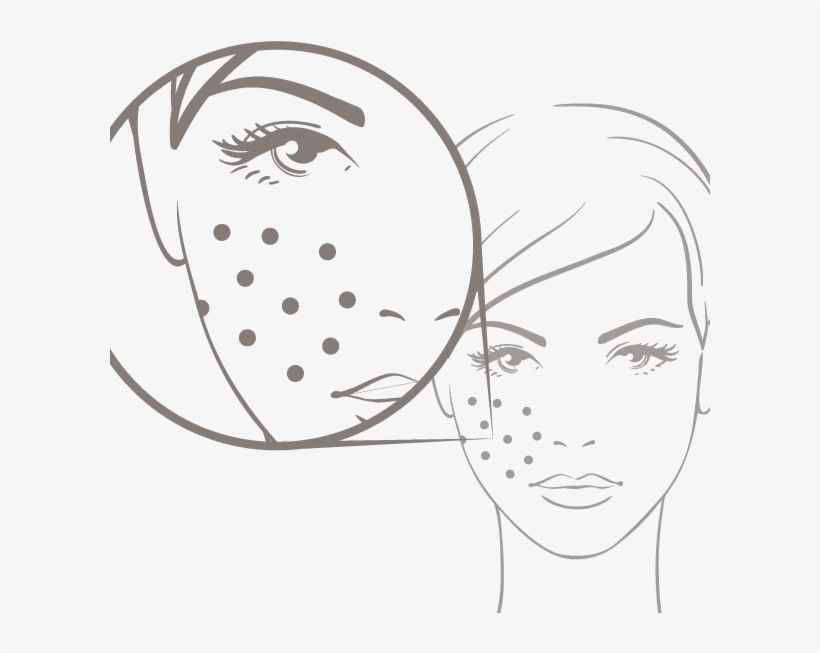 Symetrie Acne - Acne, transparent png download