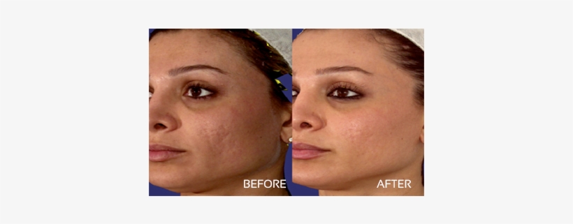 Acne Scars - Laser Skin Resurfacing Before, transparent png download