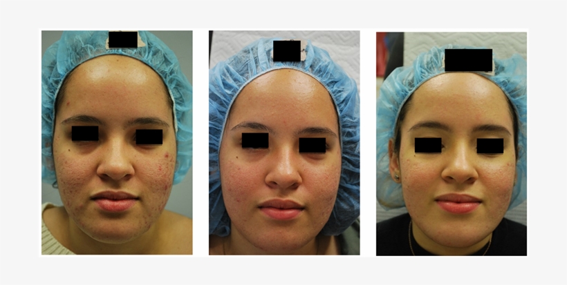 Acne, Acne Scarring And Pores Before , 1 Month Post - Mask, transparent png download
