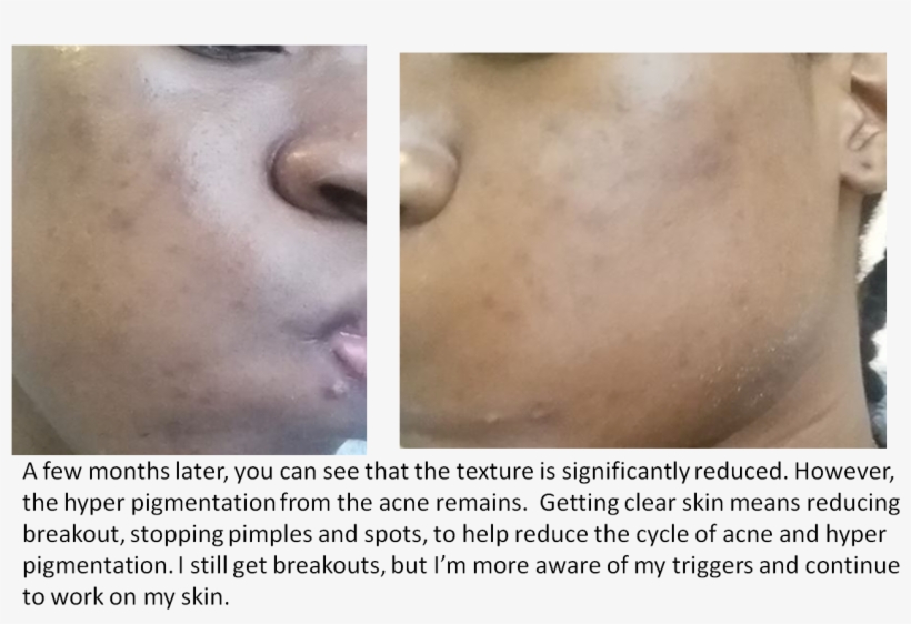 Break Out Recovery - Freckle, transparent png download