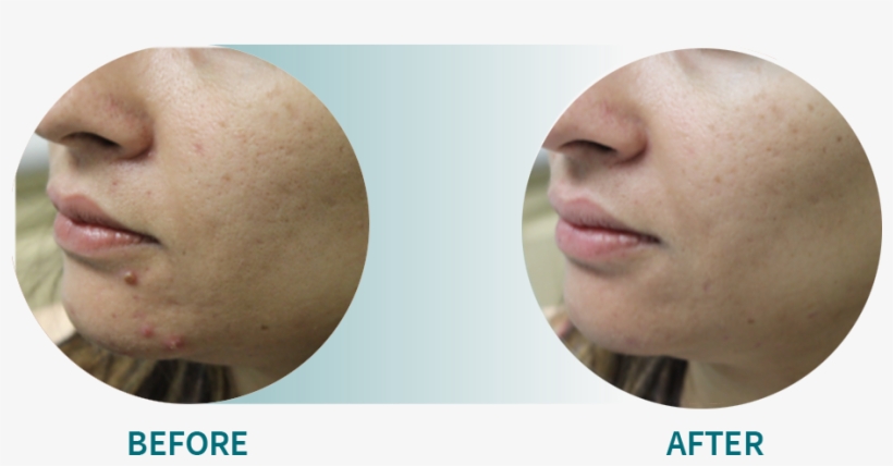 Active Acne/acne Scars - Gold, transparent png download