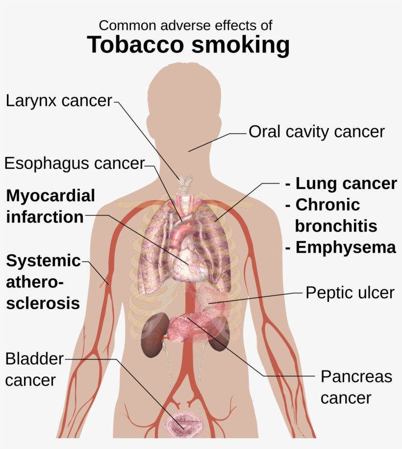 File Adverse Effects Of Smoking Png Wikimedia - Anafilakticki Sok, transparent png download