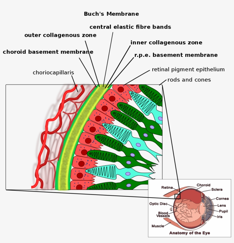 Angioid Streaks Bruch Membrane, transparent png download