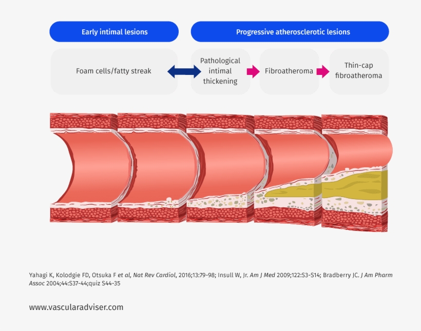 Atherosclerotic Lesion Development - Lesion, transparent png download