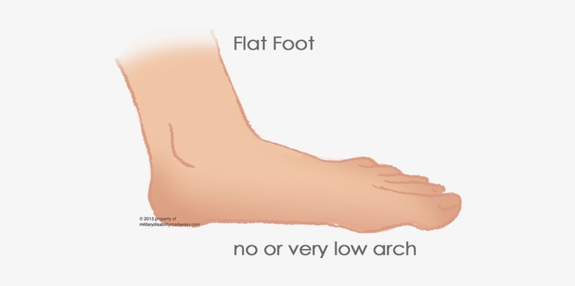 Flat Foot 1 - Flat Foot Disease, transparent png download