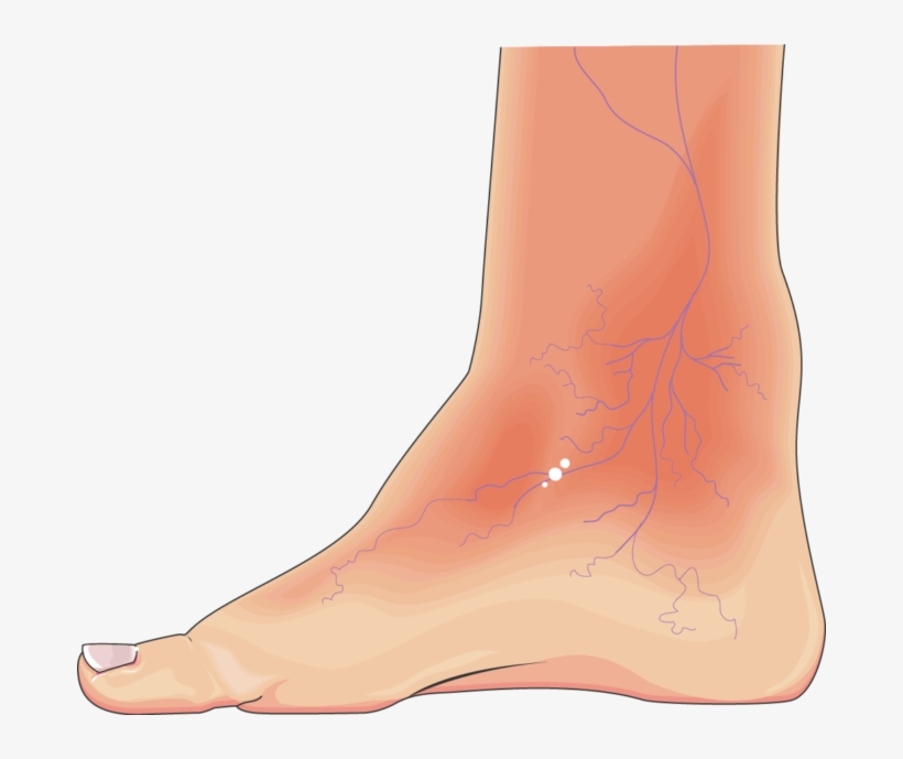 Diabetic Foot, transparent png download