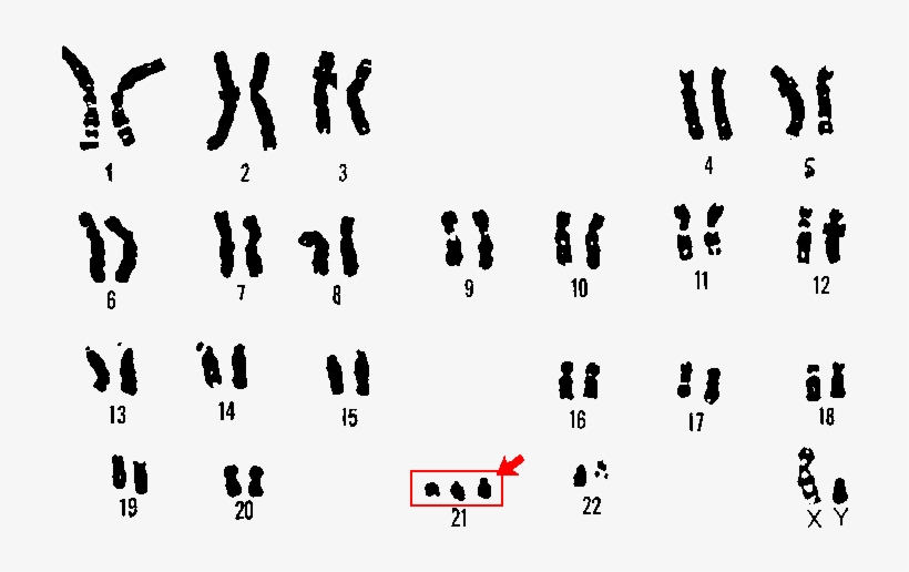 Nondisjunction Down Syndrome Karyotype, transparent png download