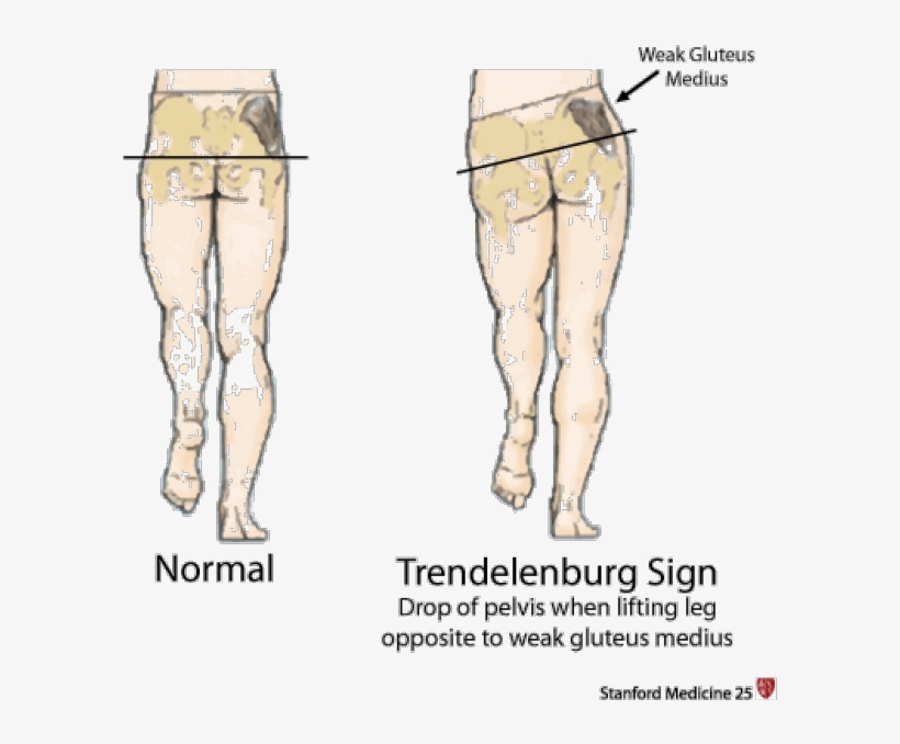 Hip Girdle Muscles Are Responsible For Keeping The - Trendelenburg Sign, transparent png download