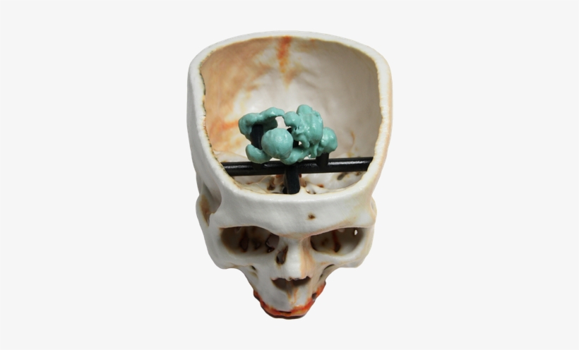 Brain Tumor 3d Print - 3d Printing, transparent png download
