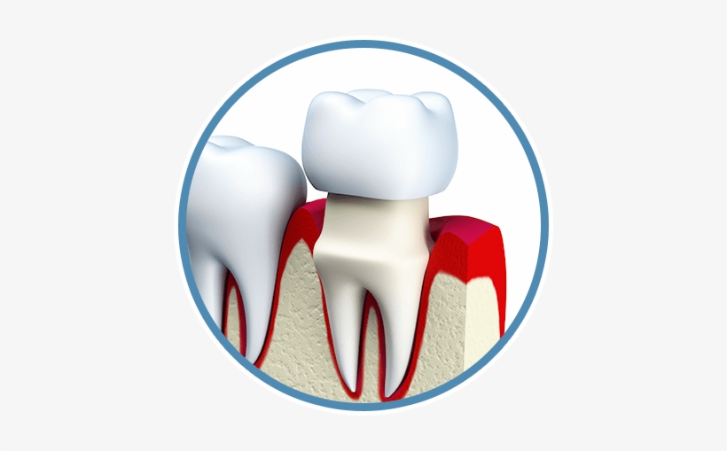 Dental Crowns - Tooth Porcelain Figure Png, transparent png download