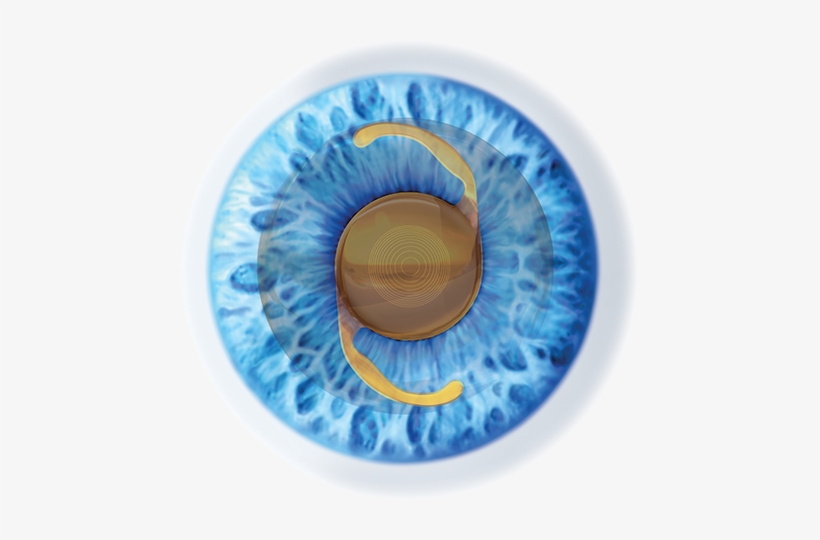 Select The Most Suitable Lens For The Patient From - Cataratta Operazione, transparent png download