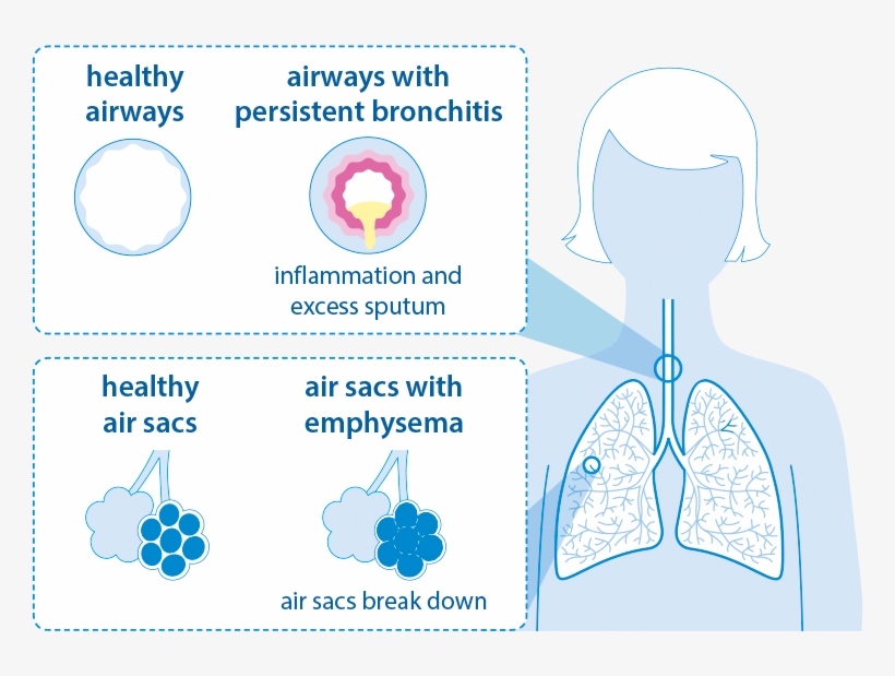 Copd Bronchitis Emphysema Graphic - Finding The Missing Millions Copd, transparent png download
