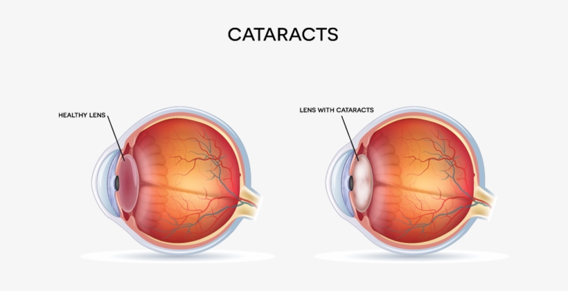 Anatomy Of The Eye With Cataracts - Diagram Of Cataract, transparent png download