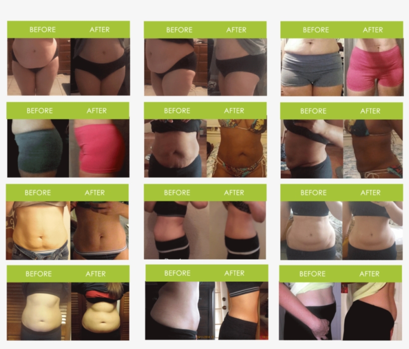 Slimbelly Before And After, transparent png download