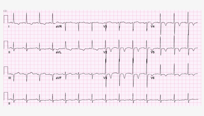 Cerebral T Waves - Electrocardiography, transparent png download
