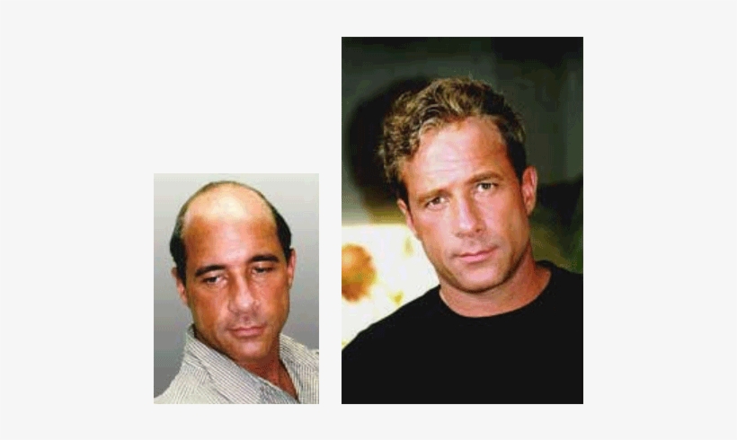 Men S Hair Replacement Systems Before And After Hair