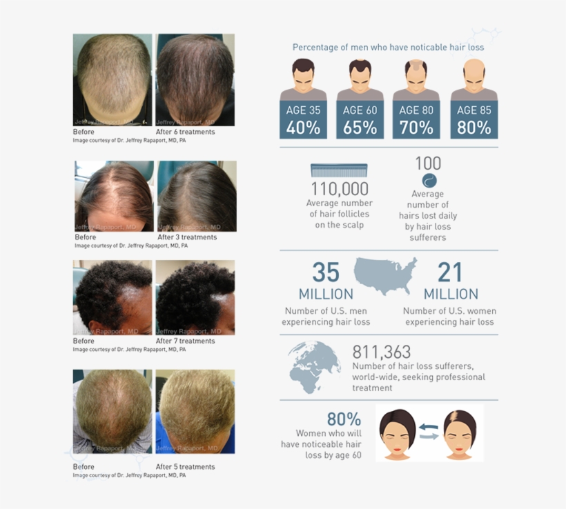 However, There Is Evidence That Regular Treatments - Prp Hair Restoration Rapaport, transparent png download