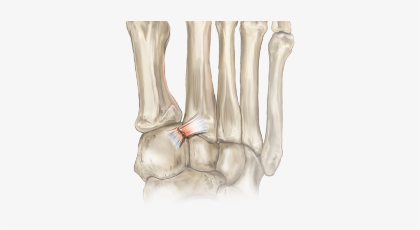 The Lisfranc Ligament Is A Strong Ligament In The Midfoot - Lesão De Turco Pé, transparent png download