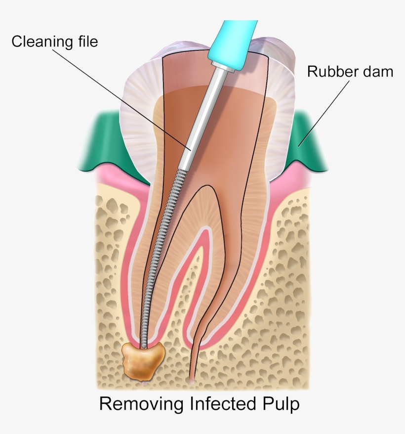 Root Canal Transparent - Artificial Nerves Root Canal, transparent png download