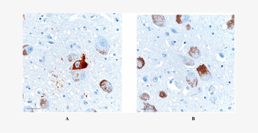 At8 Positive Neurofibrillary Tangle Is Noted In The - Neurofibrillary Tangle, transparent png download