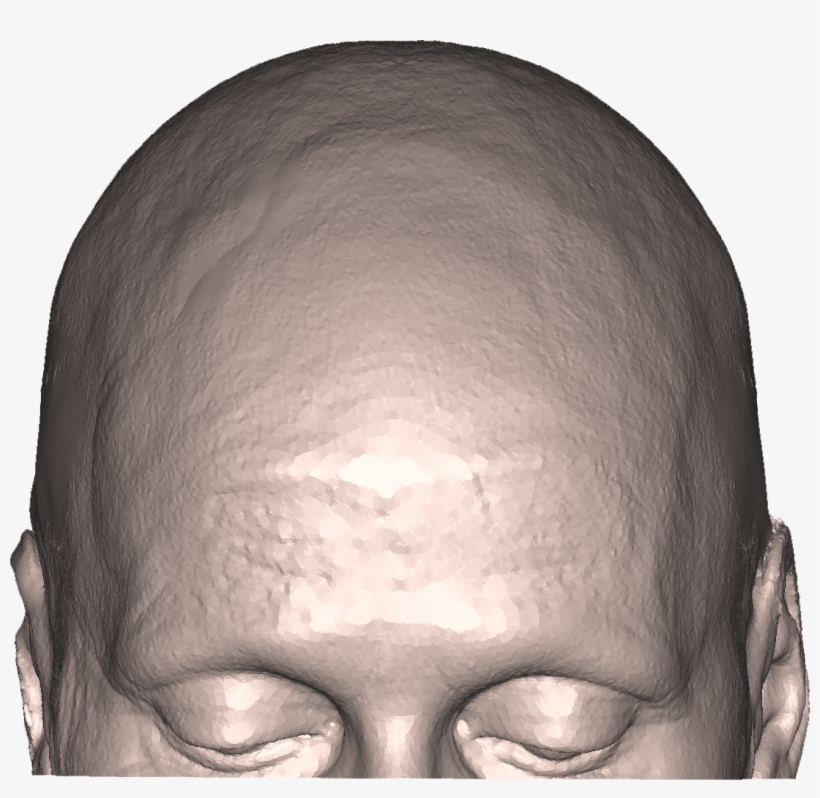 Xilloc Medical Carla Dekker Defect Skinn With An Real - Ozone Hole, transparent png download