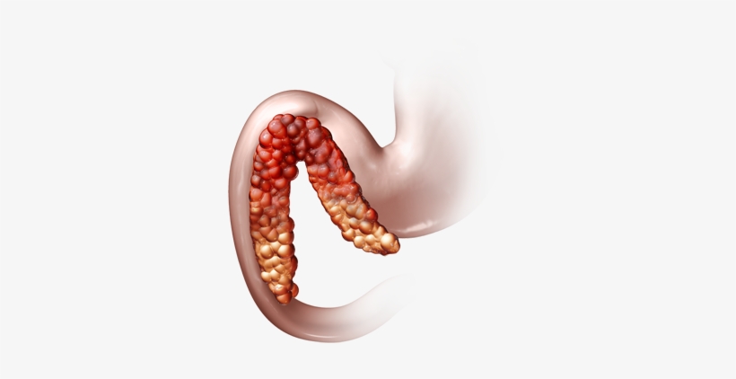 The Pancreas, While Being A Small Organ, Delivers A - Annular Pancreas, transparent png download