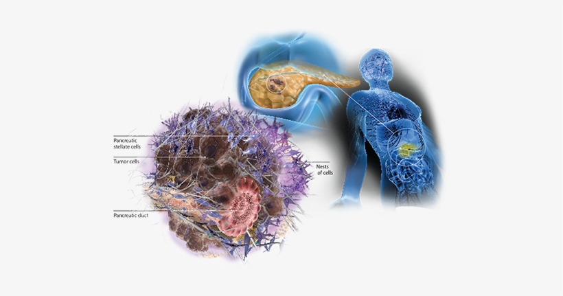 Pancreatic Cancer Illustration - Pancreatic Cancer, transparent png download