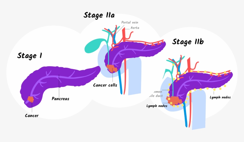 Illustration Of Stage I And Stage Iia And Iib Pancreatic - Stage 1 Stage 2 Pancreatic Cancer, transparent png download