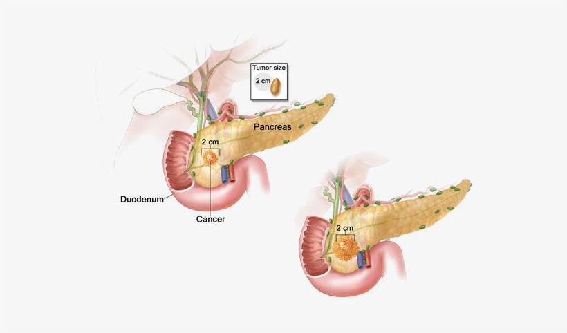 Periampullary Neoplasms - Stage 1 Pancreatic Cancer, transparent png download