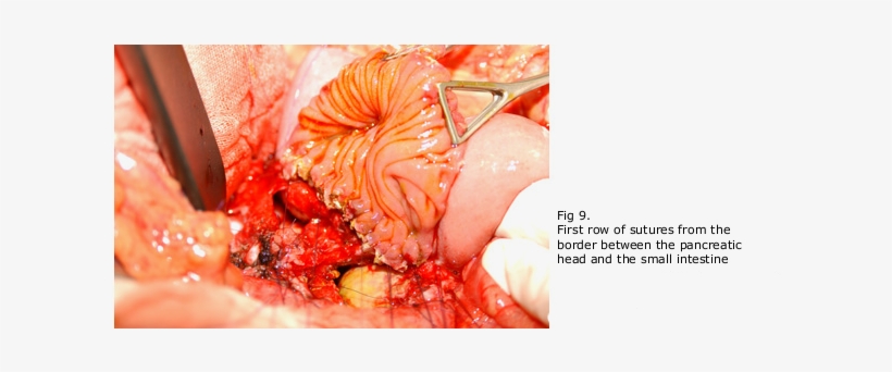 The Resection Of The Pancreatic Head With Conservation - Pancreas With Chronic Pancreatitis Transparent, transparent png download