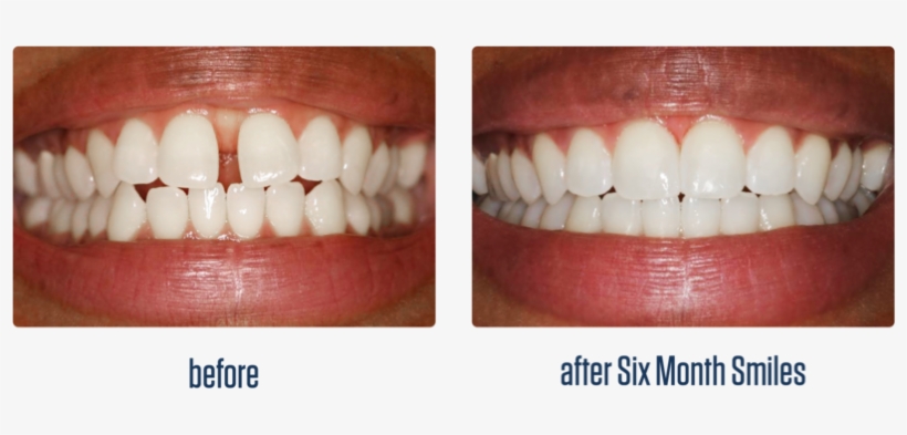 Gallery-11 - Before And After Six Month Smiles, transparent png download