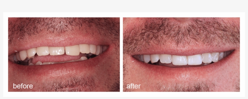 Shot Of Before And After Visiting Abington Smile Gallery - Dentist, transparent png download