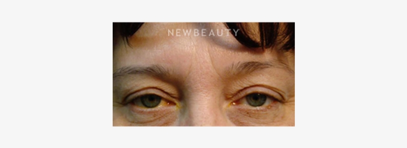 News-59574 - Blepharoplasty, transparent png download