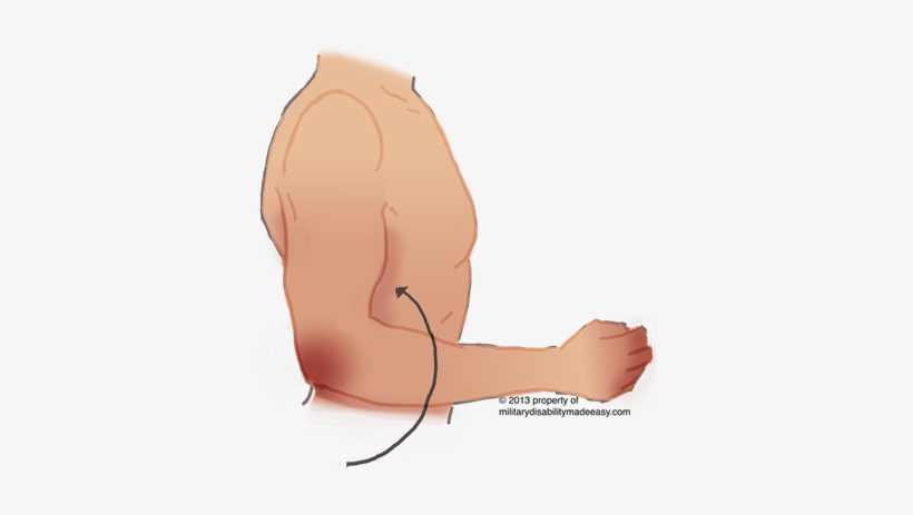Upper Nerve 29 - Damage Of Musculocutaneous Nerve, transparent png download