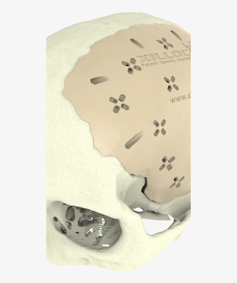 Cranial Implant - Implant, transparent png download
