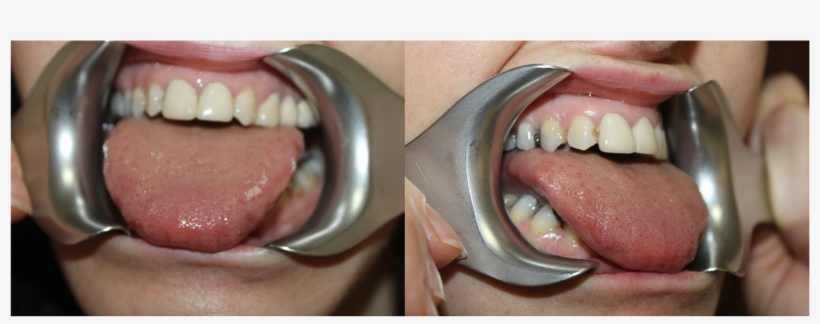 Teeth Marks On The Tongue At Rest - Teeth Rest On Tongue, transparent png download