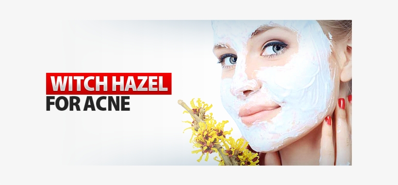 Witch Hazel For Acne - Acne, transparent png download
