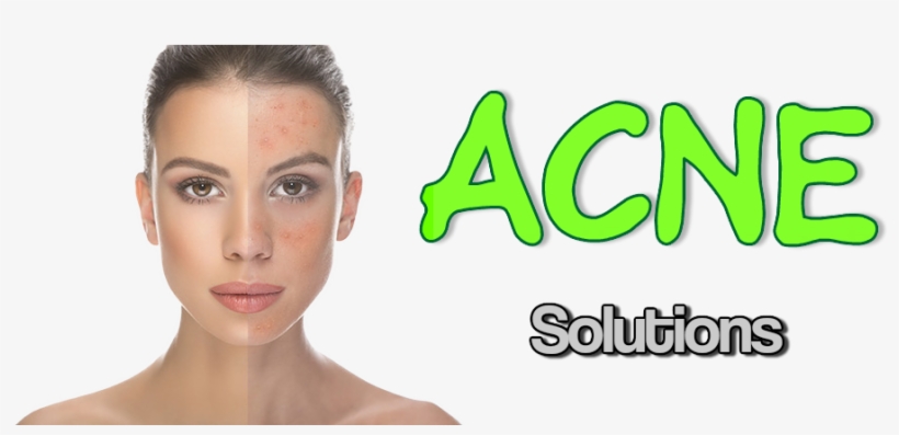 Richfeel Anti Acne Soap With Calendula Extracts (pack, transparent png download