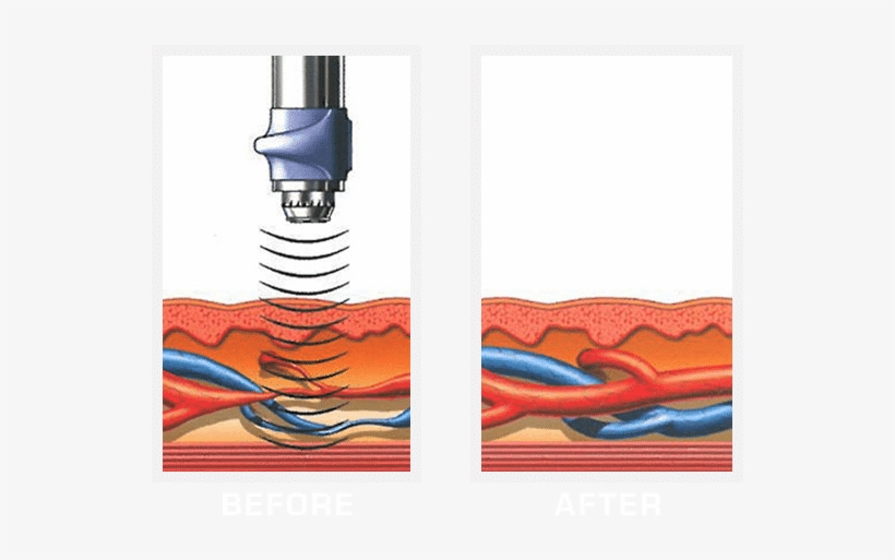 Gainswave For Erectile Dysfunction Gainswave Before And After