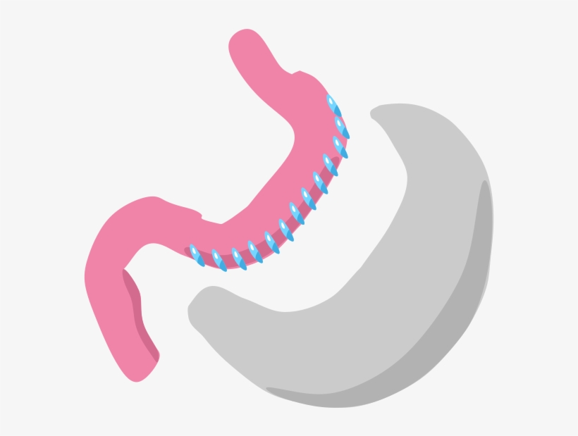 Fig 1 In A Sleeve Gastrectomy, The Greater Curvature - Gastrectomia Vertical, transparent png download